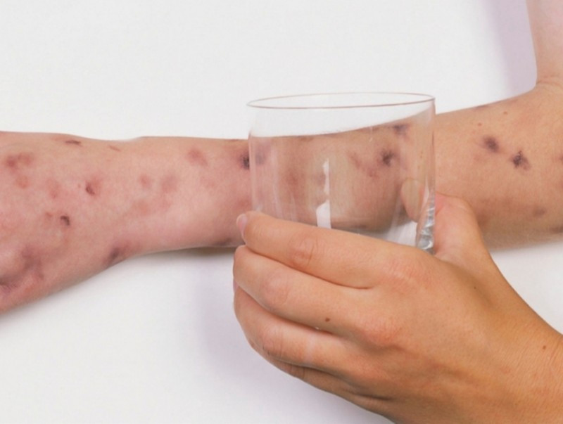 Менингококкт нь богино хугацаанд хүндэрч болзошгүй аюултай халдвар юм